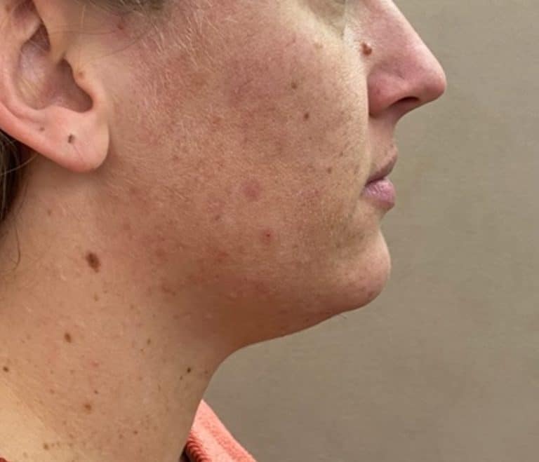 Quantum RF Contouring - Case 8715 - Before