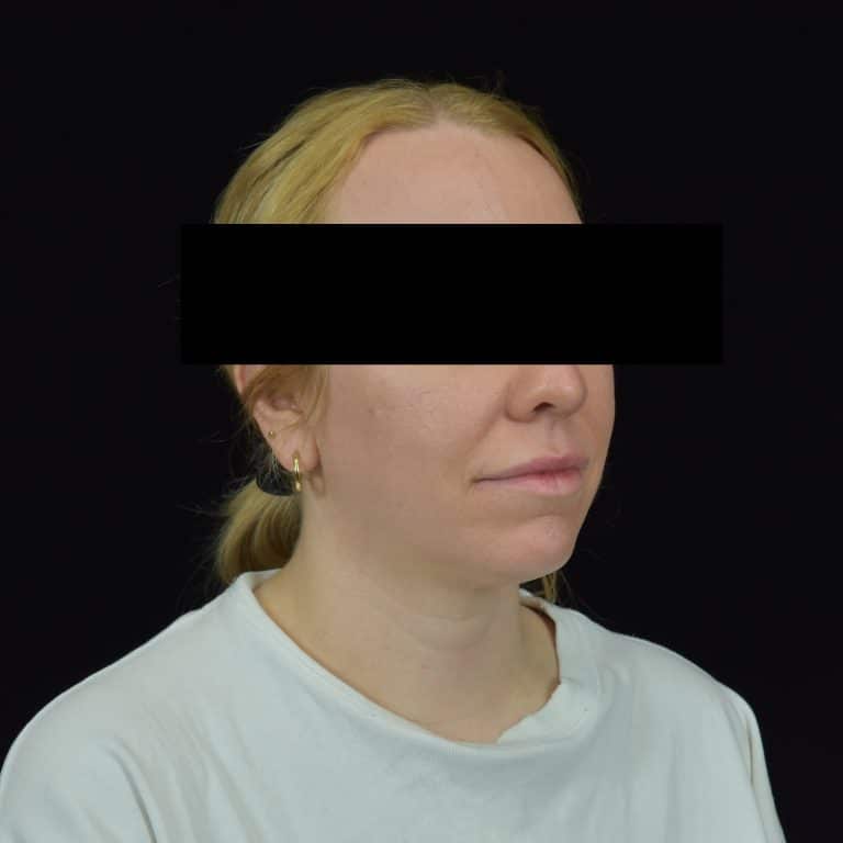 Quantum RF Contouring - Case 8724 - Before