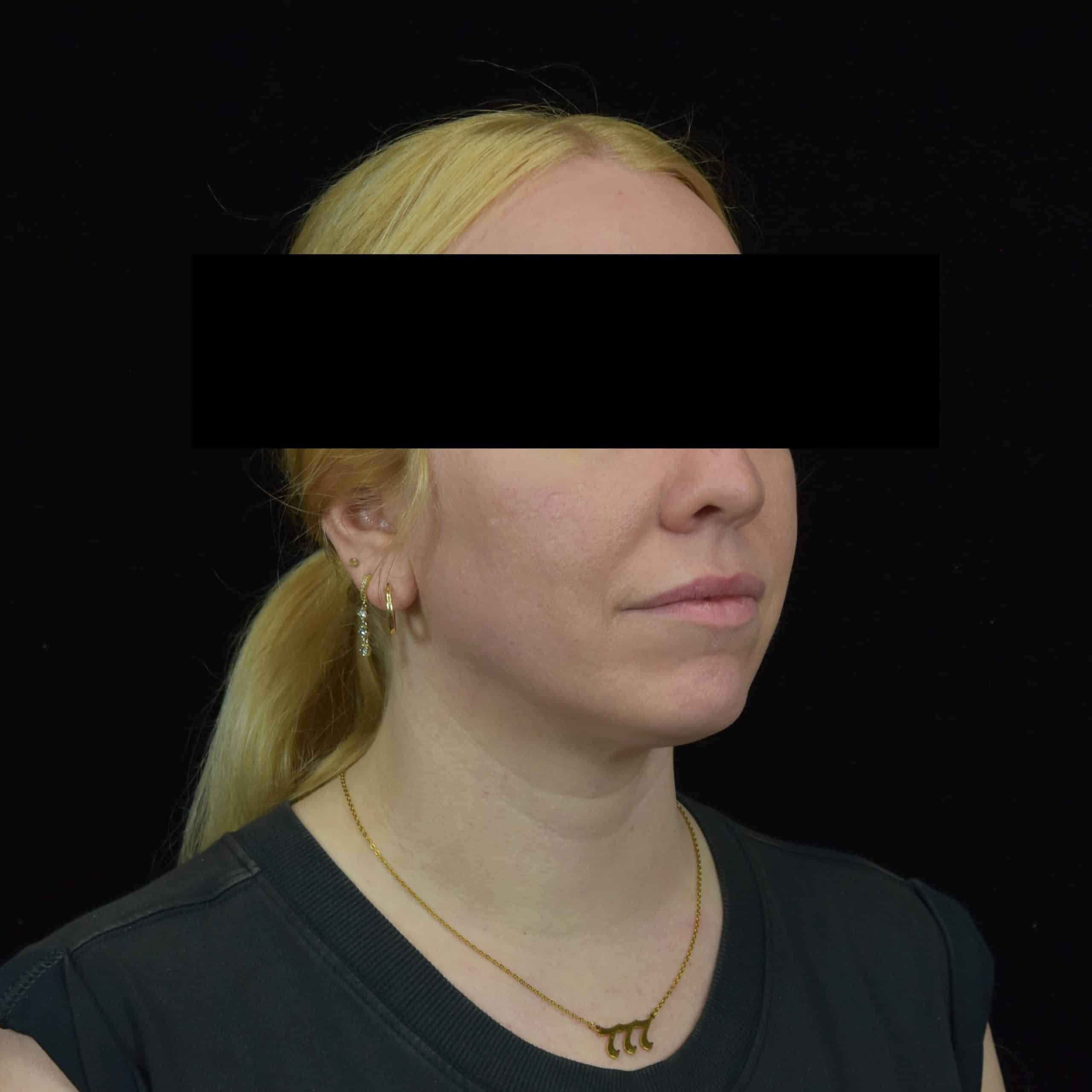 Quantum RF Contouring Patient Photo - Case 8724 - after view