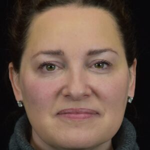 A patient's refined results after receiving Juvederm in Ann Arbor.