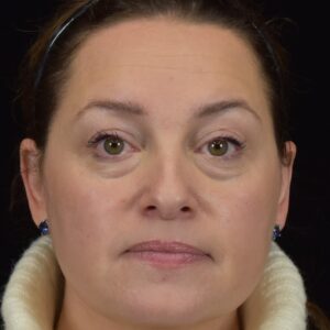 A patient's face prior to her appointment for Juvederm in Ann Arbor.