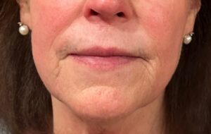 A patient's lower face after her appointment for laser skin resurfacing in Ann Arbor.